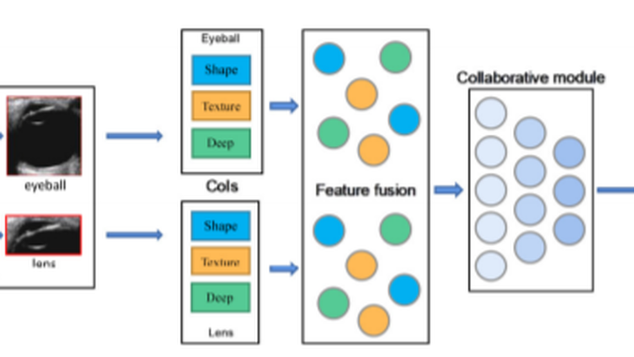 Cataract detection based on ocular B-ultrasound images by collaborative monitoring deep learning.